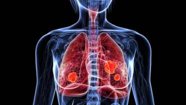 Two New Targets Discovered for NSCLC Treatments