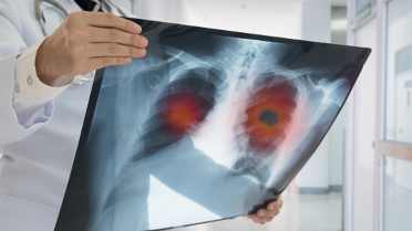 Radiation after Immunotherapy Improves PFS in NSCLC