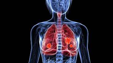 Anti PD-L1 Therapy Improves Long-Term Survival in Advanced NSCLC