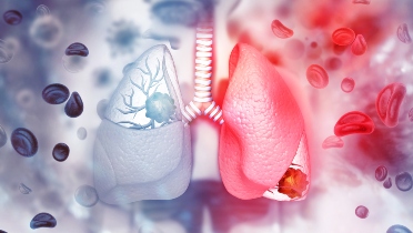 Nivolumab Loses Small Cell Lung Cancer Indication