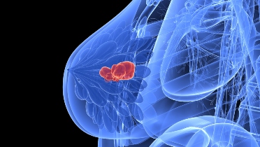 FDA Approval in BRCA Mutated HER2-negative High-Risk Early Breast Cancer