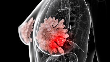 Lumpectomy, Mastectomy Result in Similar Outcomes in Younger Patients with Breast Cancer