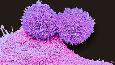 Protein Coding Gene Enhances Cisplatin Resistance in Triple-Negative Breast Cancer