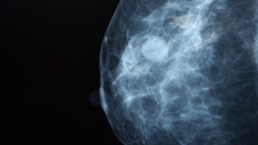 FDA Approves AI Algorithms for Breast Cancer Detection