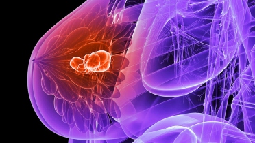 ASCO, SSO Publish Guidelines for Germline Mutation Testing in Breast Cancer